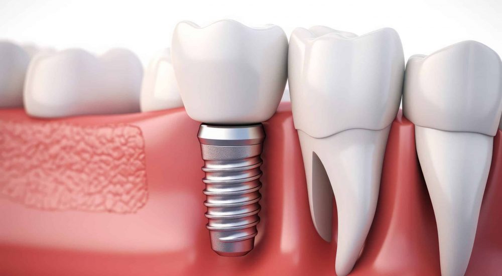 Why Dental Implants Are the Ideal Solution for Missing Teeth